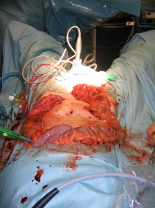 On the operating table