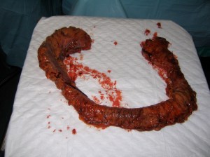 My diseased Large Intestine