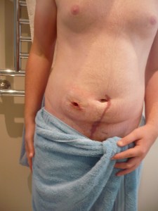 Scars - where my ileostomy used to be